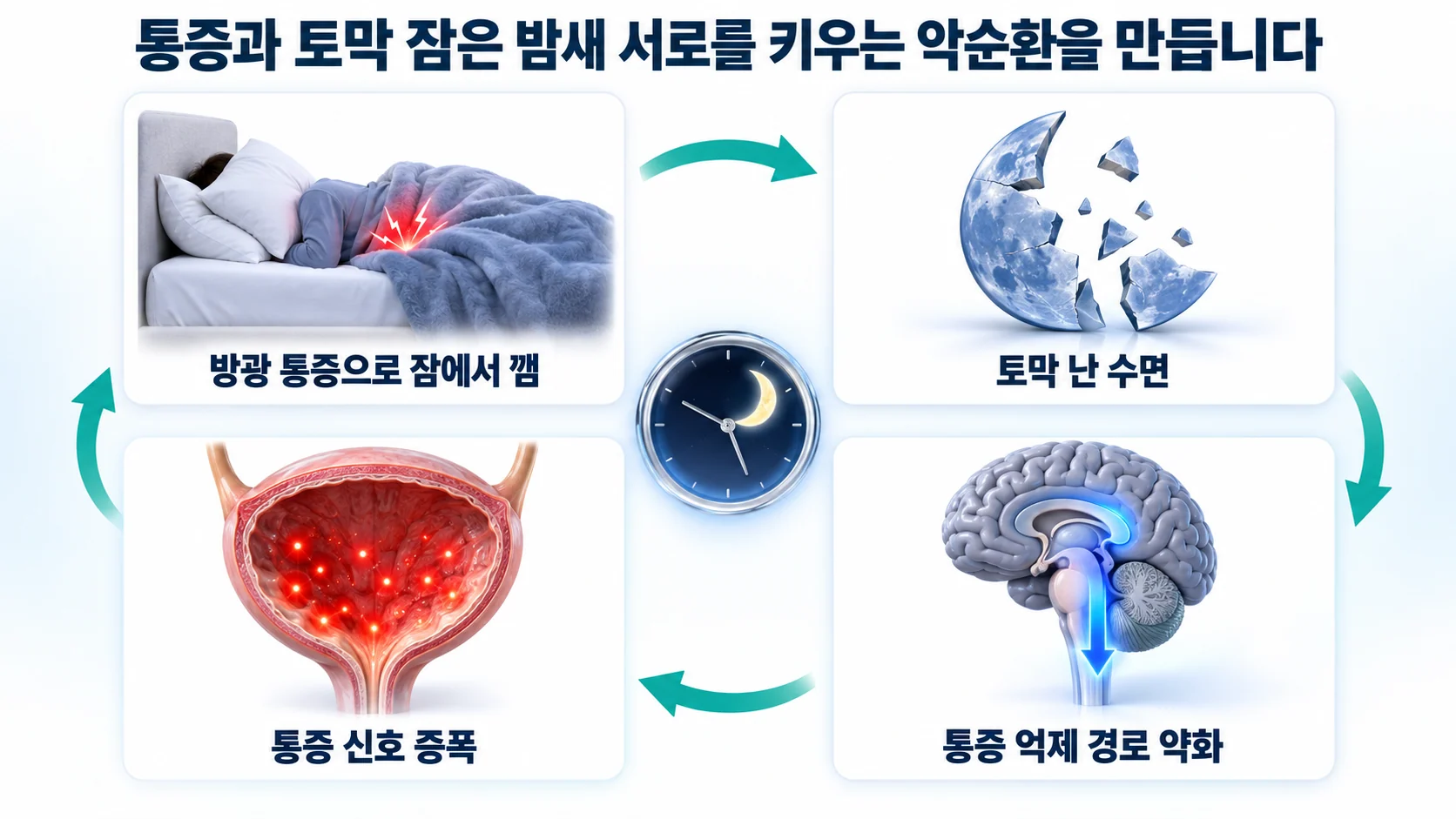 방광 통증으로 깸, 토막 난 수면, 통증 억제 경로 약화, 통증 신호 증폭으로 이어지는 악순환을 나타낸 3D 도식