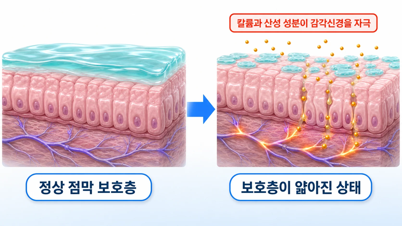 방광 점막의 보호층이 얇아지면 소변 속 칼륨과 산성 성분이 스며들어 감각신경을 자극하는 과정을 정상 상태와 나란히 비교한 그림