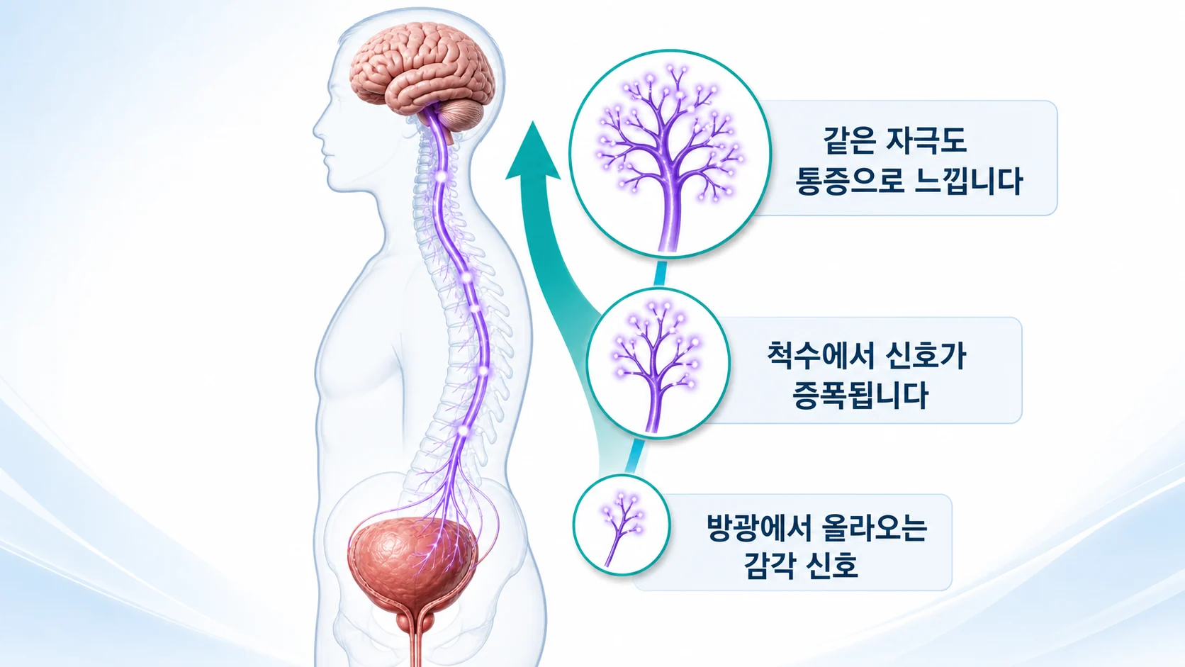 방광에서 올라온 감각 신호가 척수와 뇌를 지나며 증폭되어 같은 자극도 통증으로 느끼게 되는 중추감작 과정을 그린 그림