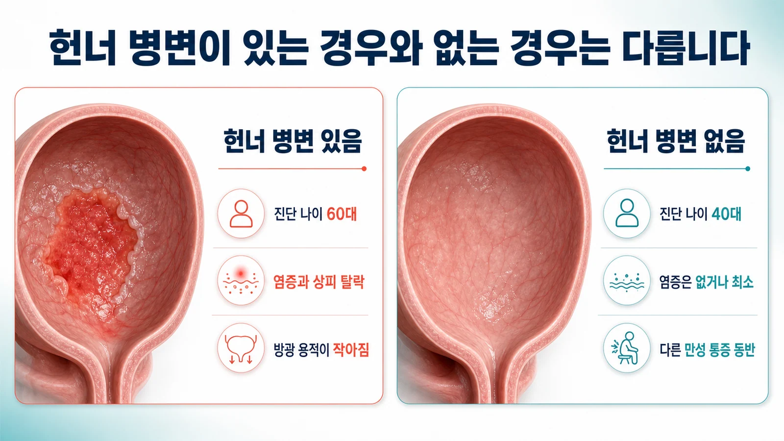 헌너 병변이 있는 경우와 없는 경우를 비교한 그림. 병변이 있는 쪽은 진단 나이 60대, 염증과 상피 탈락, 방광 용적 감소로, 없는 쪽은 진단 나이 40대, 염증은 없거나 최소, 다른 만성 통증 동반으로 정리되어 있다