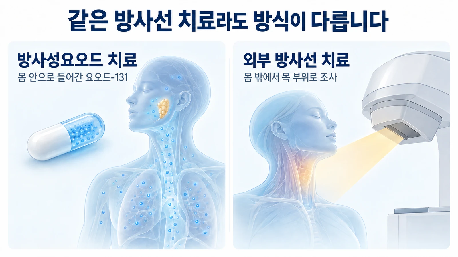 방사성요오드 복용과 몸 밖에서 목에 조사하는 방사선 치료의 차이를 설명한 그림