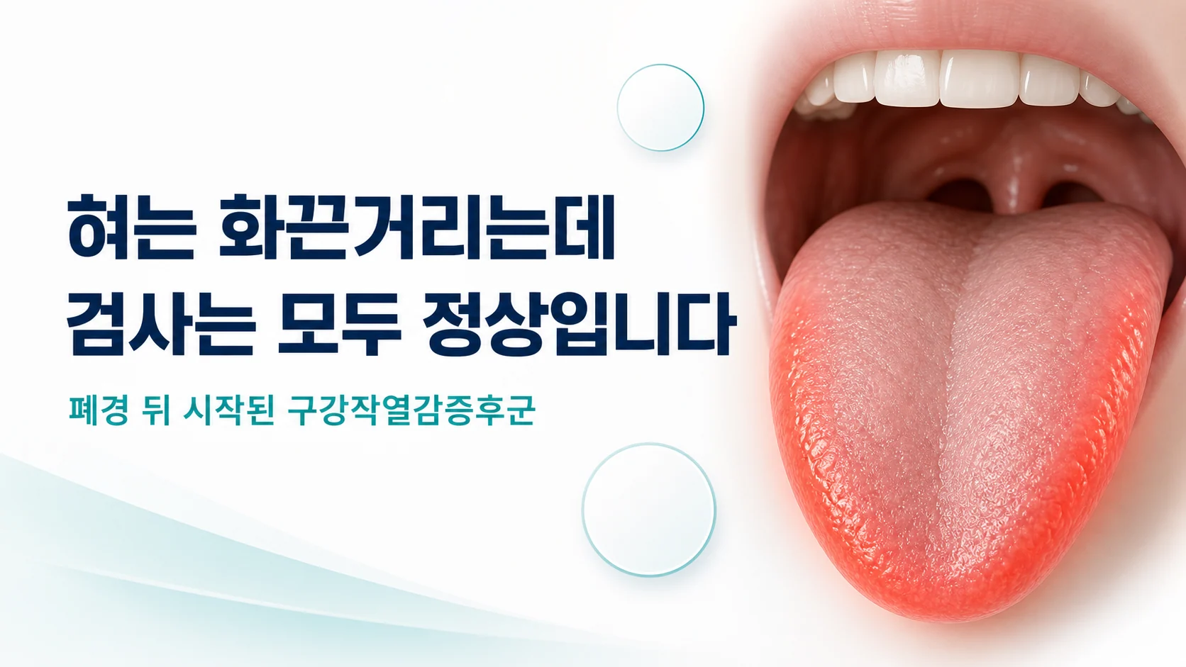 혀 끝과 옆으로 붉은 열감이 번지는 구강 모형과 함께 혀는 화끈거리는데 검사는 모두 정상입니다라는 문구가 적힌 안내 이미지