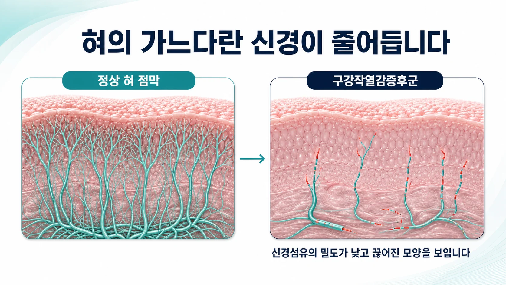 정상 혀 점막과 구강작열감증후군 환자의 혀 점막에서 신경섬유 밀도를 비교한 그림