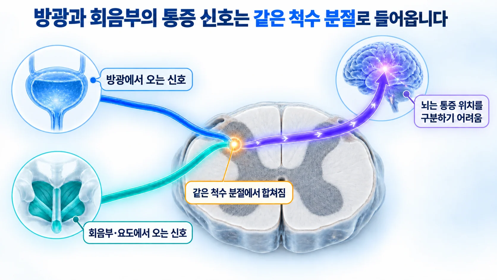 방광에서 오는 신호와 회음부·요도에서 오는 신호가 같은 척수 분절에서 합쳐져 뇌로 올라가는 구조를 보여 주는 3D 도식