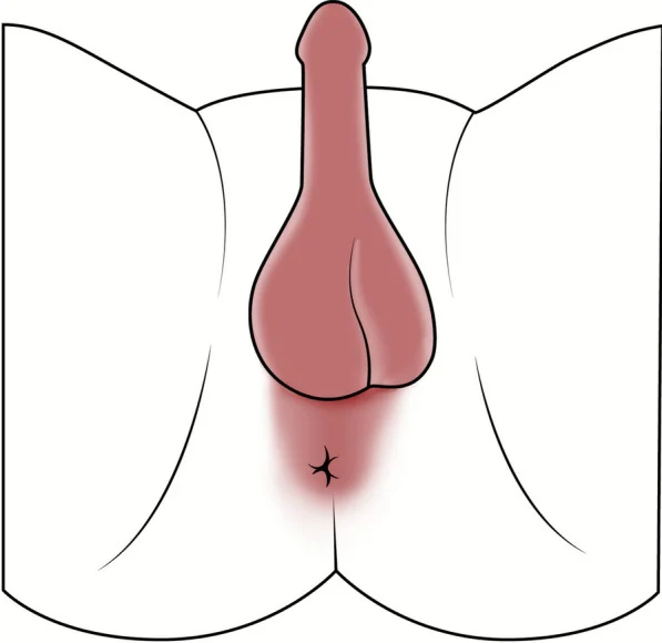 논문 그림 4. 남성 쇄석위 자세에서 양측 음부신경통의 통증 분포