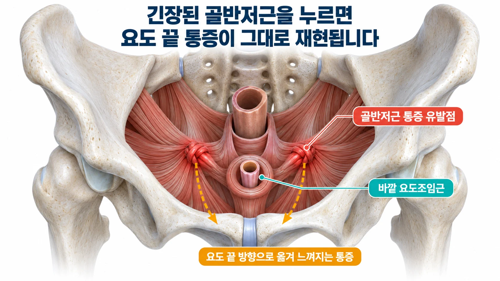 골반 안에서 내려다본 골반저근에 표시된 통증 유발점과 요도 끝 방향으로 옮겨 느껴지는 통증 경로를 보여 주는 3D 그림