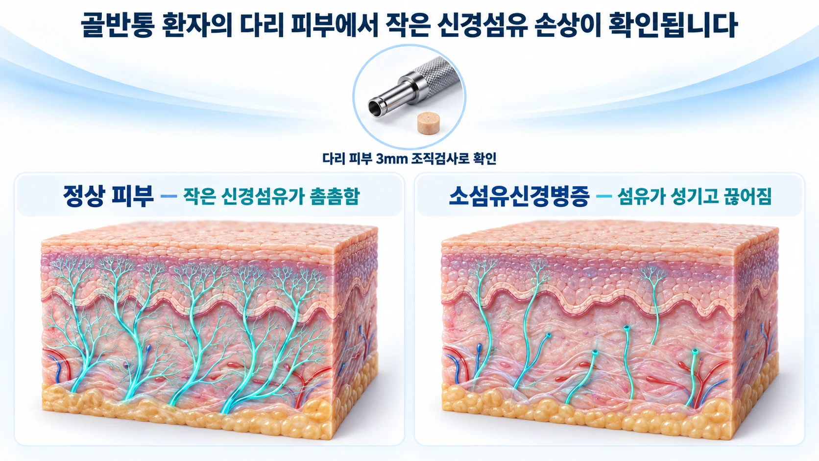 정상 피부와 소섬유신경병증 피부의 표피 신경섬유 밀도를 비교한 3D 단면 그림