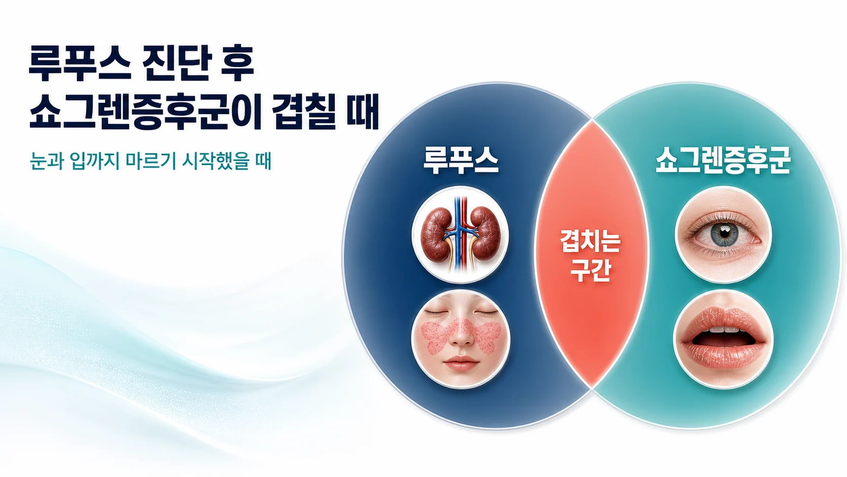 루푸스와 쇼그렌증후군이 겹치는 구조를 보여주는 개념도