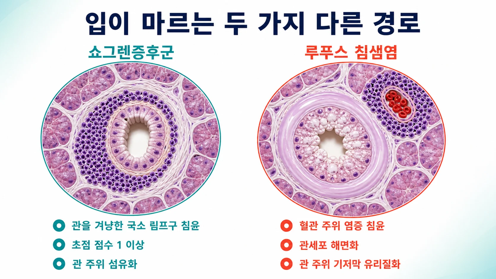 쇼그렌증후군과 루푸스 침샘염의 조직 소견 차이를 대비한 개념도