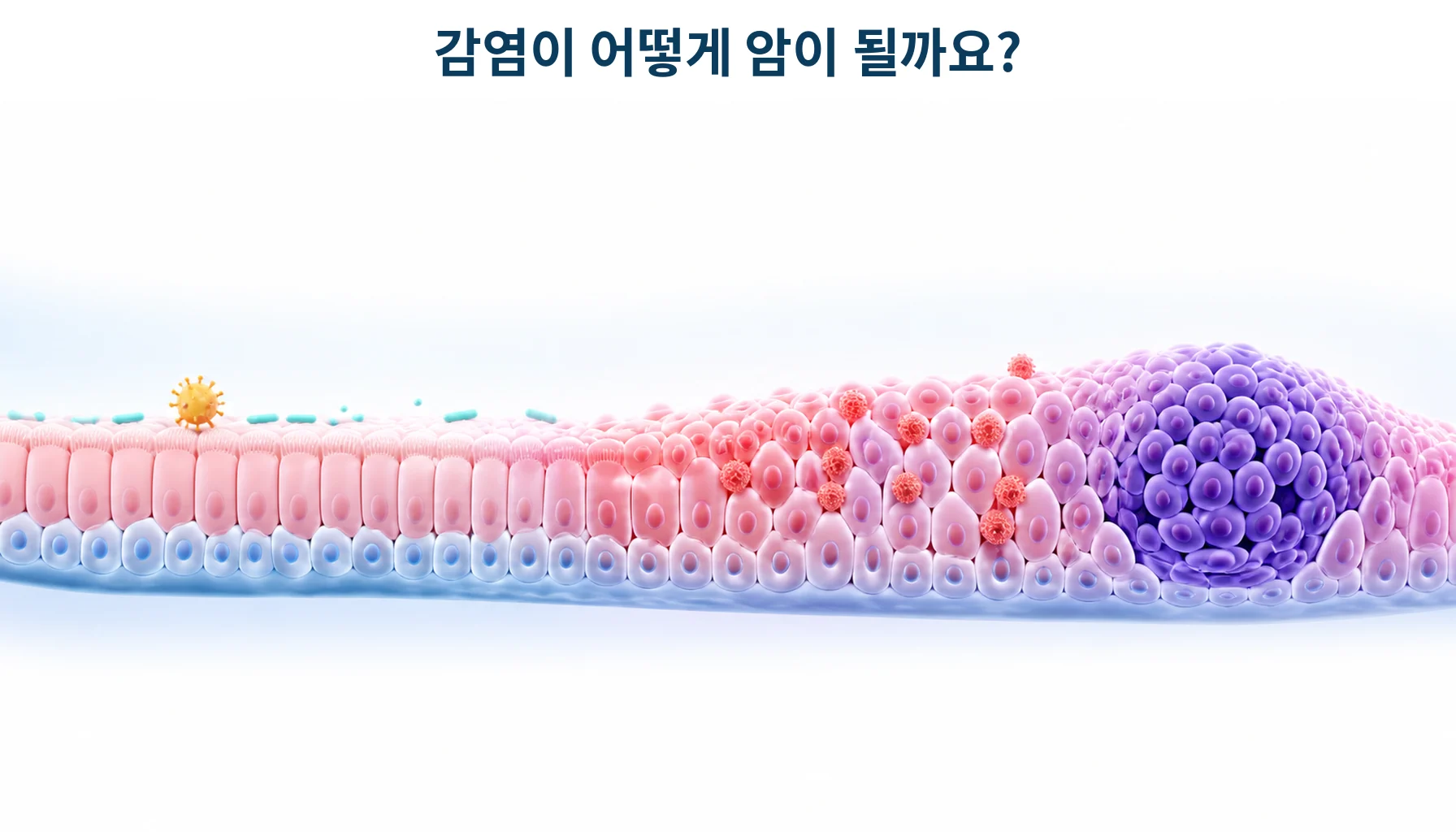 만성 감염이 오랜 시간에 걸쳐 조직을 바꾸어 암이 생기는 과정을 형상화한 개념 그림
