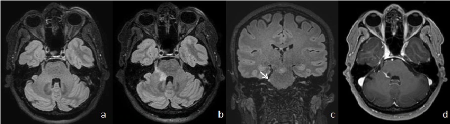 원문 증례의 MRI 네 패널에서 오른쪽 교뇌와 삼차신경 진입부 및 신경 구간의 이상을 보여주는 그림