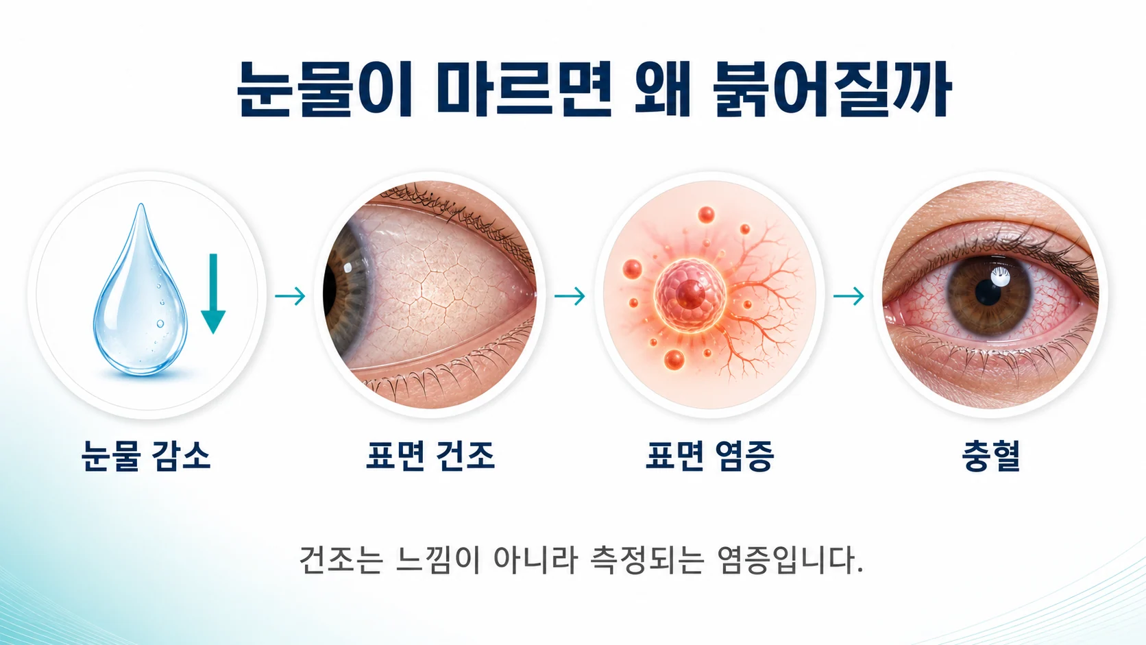 쇼그렌에서 눈물 부족이 안구 표면 염증과 충혈로 이어지는 과정을 설명하는 이미지