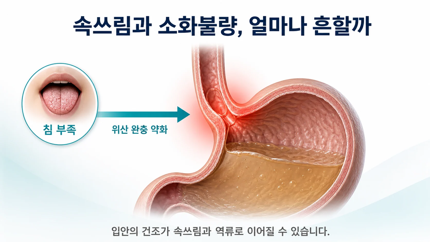 쇼그렌증후군 환자에서 속쓰림과 소화불량 역류 증상이 흔하게 나타남을 보여주는 이미지