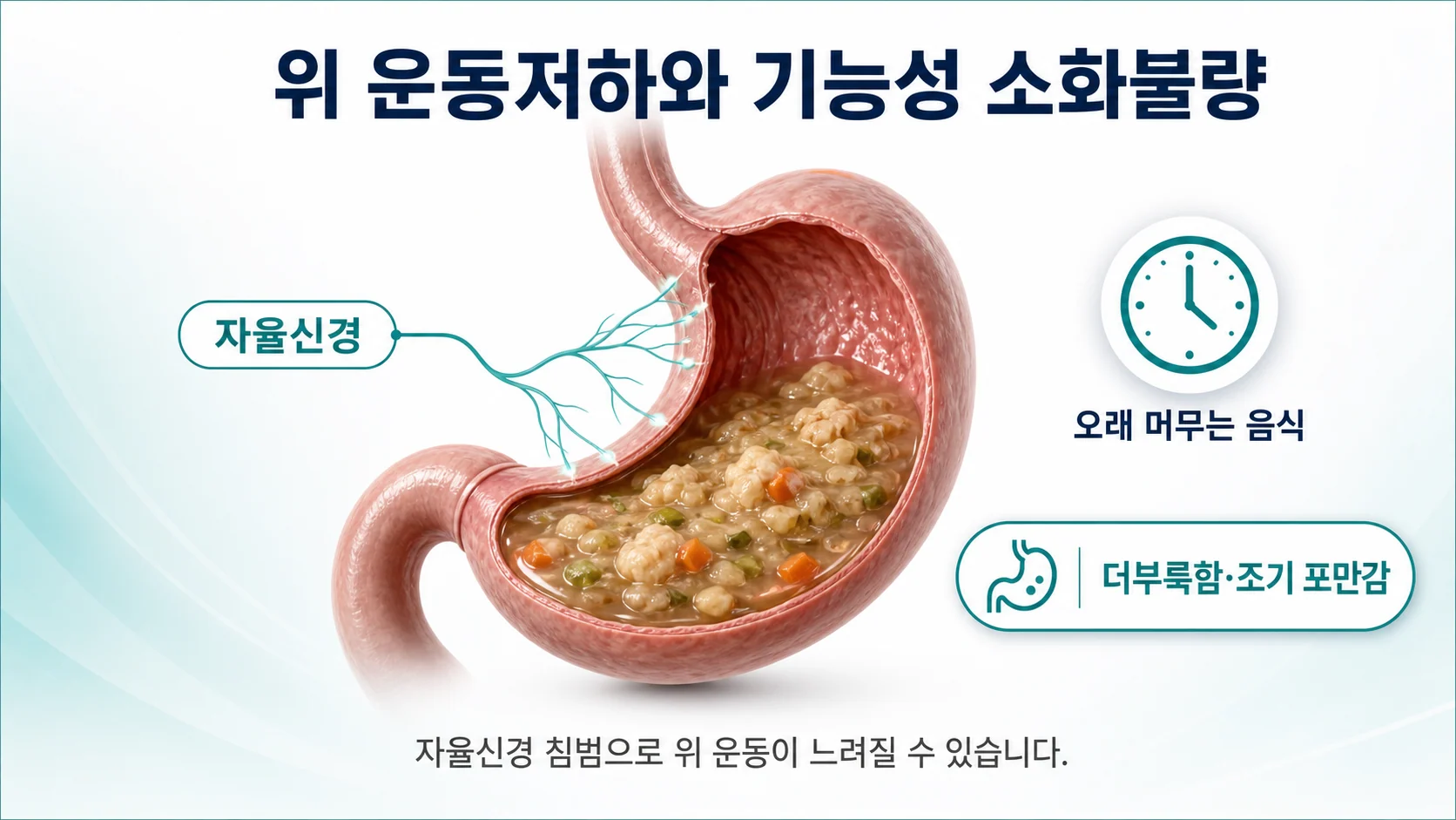 쇼그렌증후군에서 자율신경 침범으로 위 운동이 느려져 음식이 오래 머무는 기능성 소화불량 기전 이미지