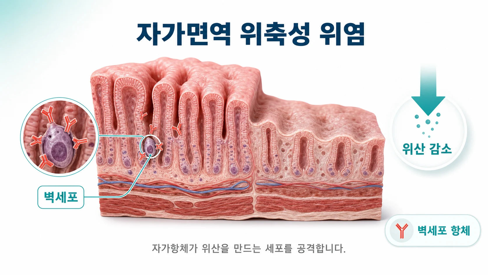 쇼그렌에서 자가항체가 위산을 만드는 벽세포를 공격해 위축성 위염이 생기는 과정을 설명하는 이미지