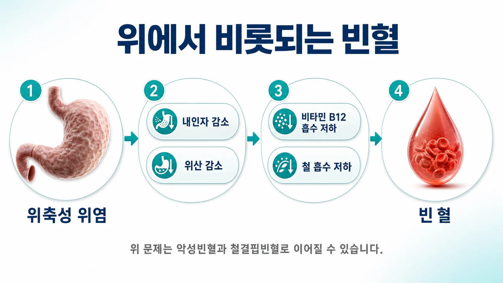 위축성 위염으로 내인자와 위산이 부족해져 비타민 B12와 철 흡수가 떨어지고 빈혈이 생기는 과정을 설명하는 이미지