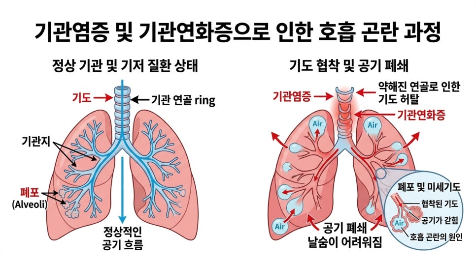 기관 CT 소견