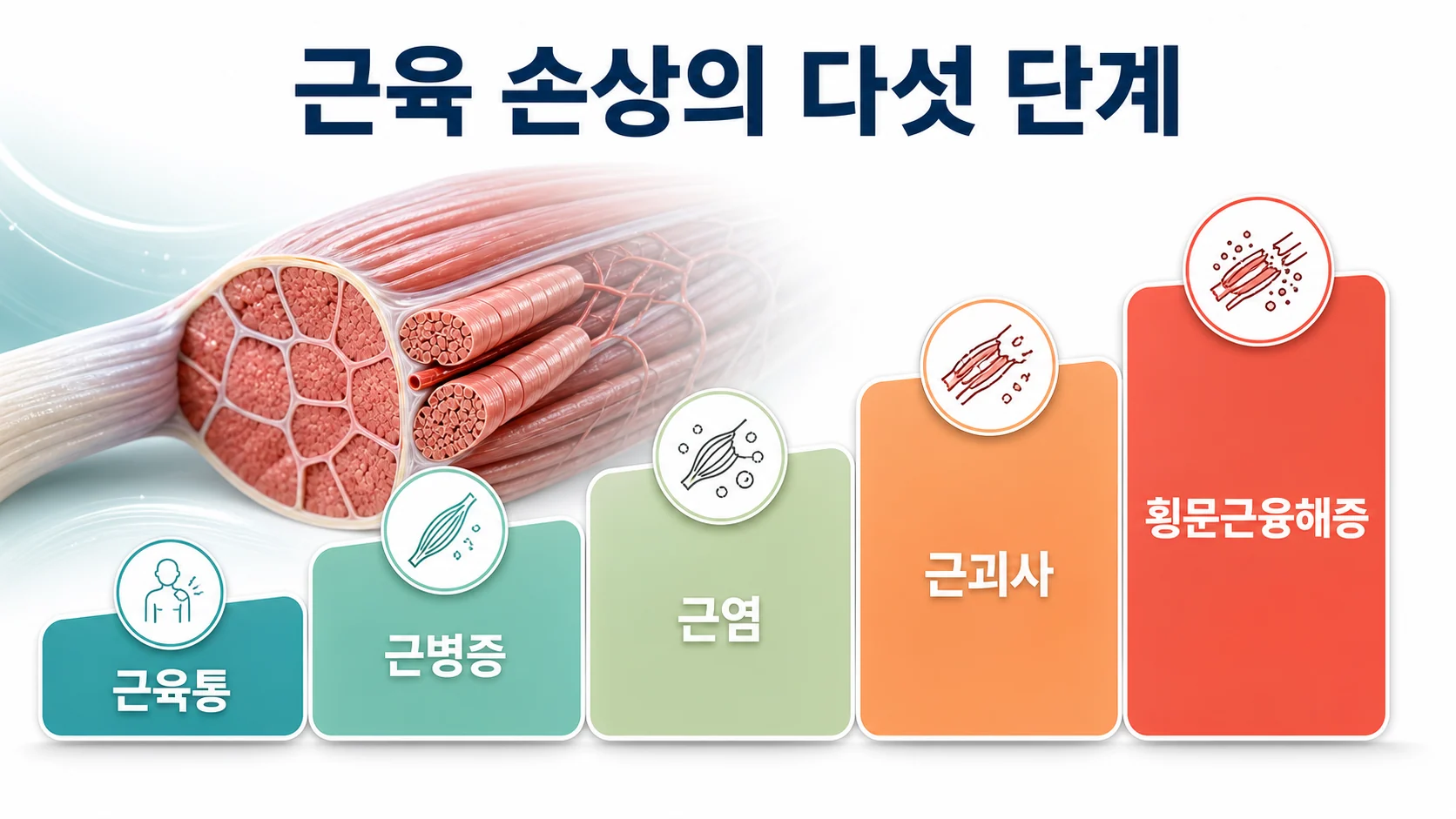 스타틴 관련 근육 증상을 근육통 근병증 근염 근괴사 횡문근융해증의 다섯 단계로 정리한 그림