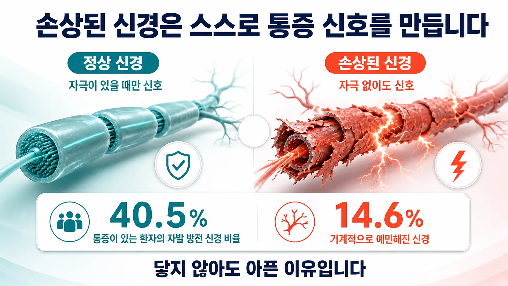 손상된 소섬유가 자극 없이 스스로 통증 신호를 만들어내는 자발 방전을 표현한 도해