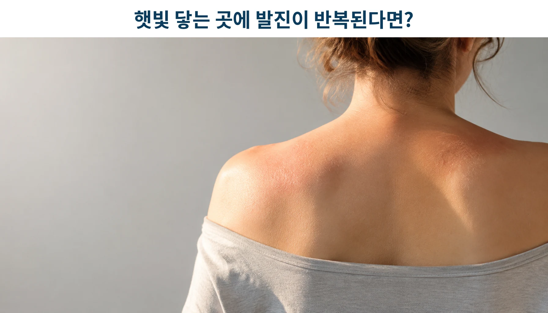 햇빛이 닿는 부위에 발진이 생기는 모습을 형상화한 개념 그림