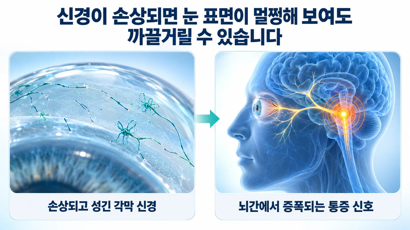 손상되고 성긴 각막 신경과 뇌간에서 증폭되는 통증 신호를 나란히 보여 주는 두 패널 그림