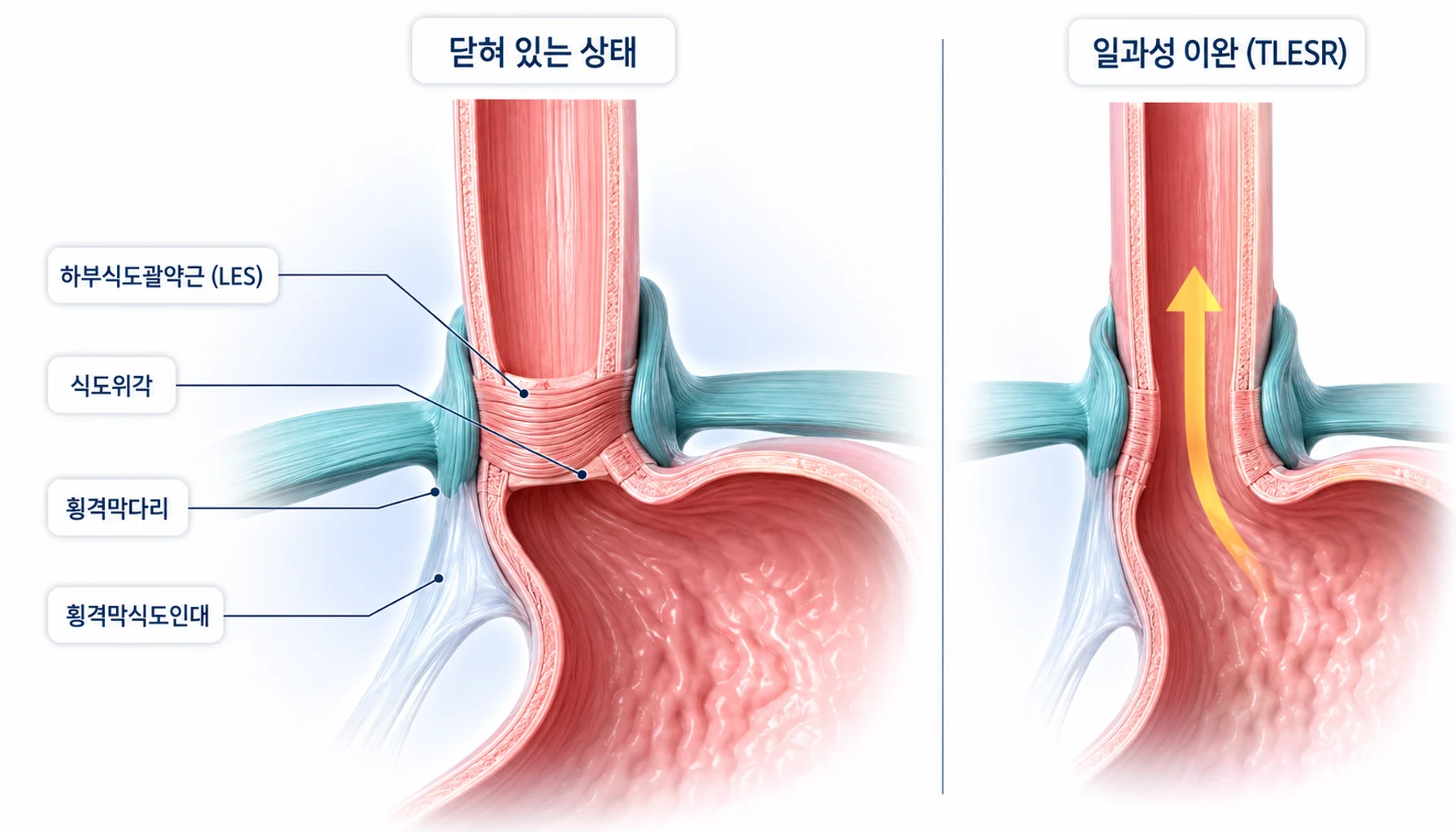 식도와 위가 만나는 접합부의 역류 방어 구조를 하부식도괄약근·식도위각·횡격막다리·횡격막식도인대로 나누어 표시한 그림