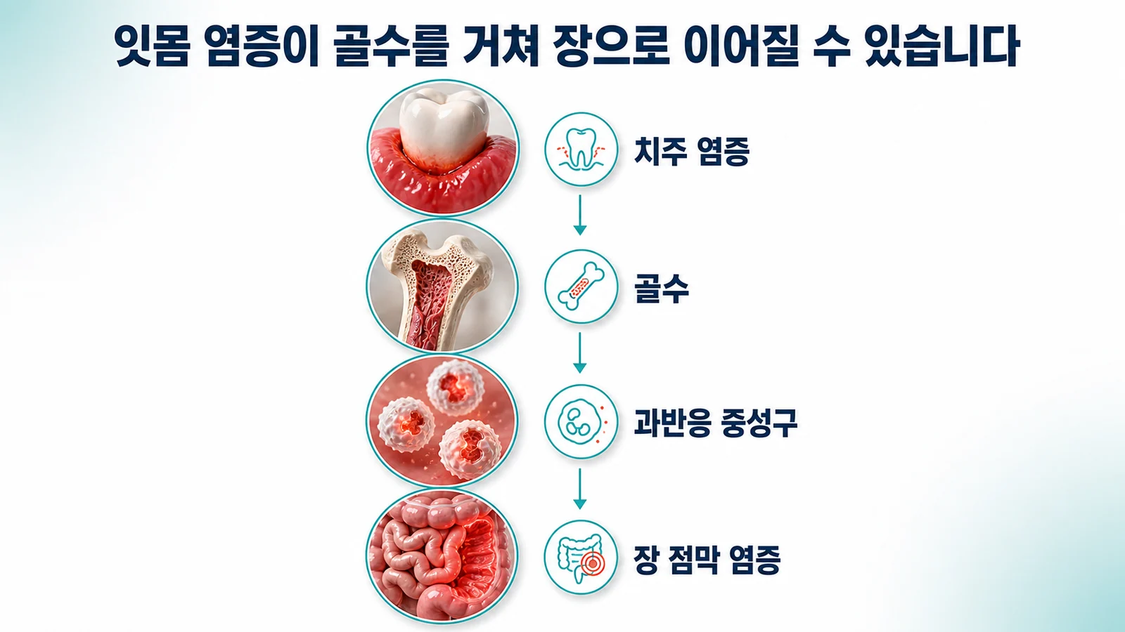 잇몸 염증이 골수를 거쳐 장으로 이어지는 흐름을 위에서 아래로 정리한 그림. 치주 염증, 골수, 과반응 중성구, 장 점막 염증 순서로 배치되어 있다