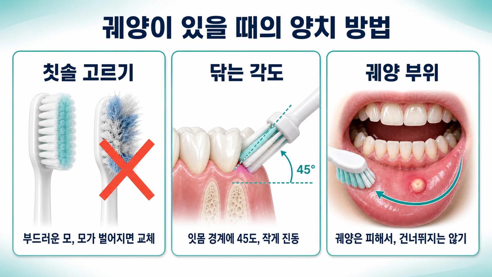 아프타성 구내염이 있을 때의 양치 방법을 단계로 보여주는 개념도