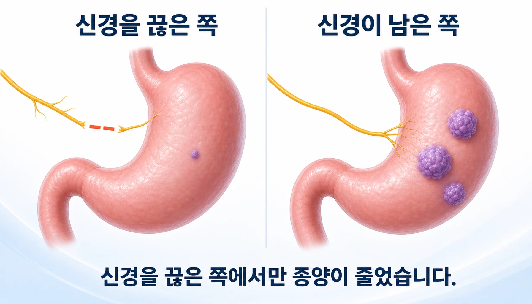 위로 가는 신경을 끊은 쪽에서만 종양이 줄어든 실험을 그린 그림