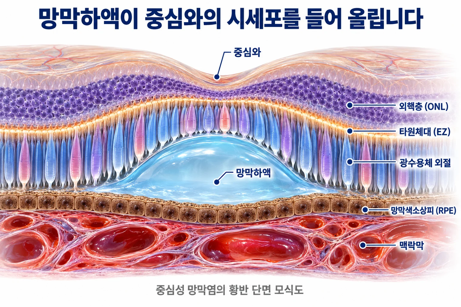 망막하액이 들어 올린 중심와 단면에서 광수용체 외절, 타원체대, 외핵층, 망막색소상피, 맥락막의 위치를 표시한 모식도