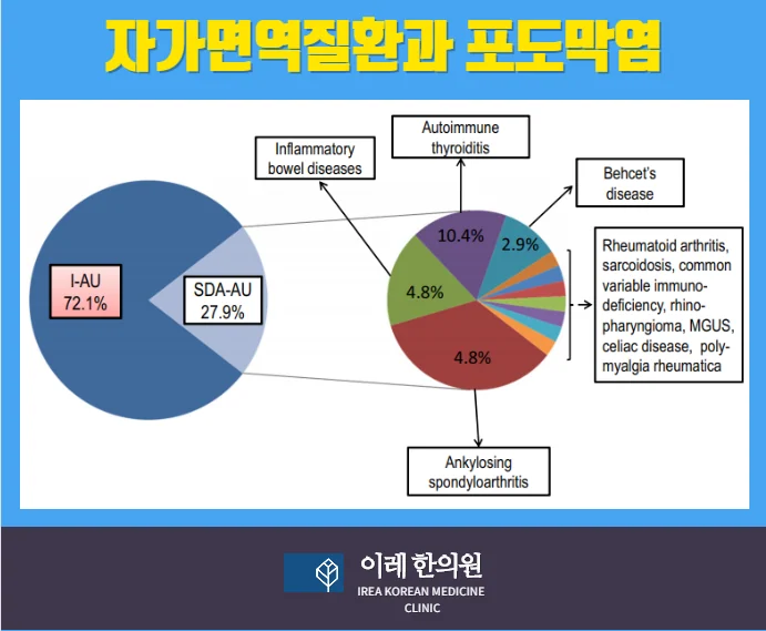포도막염, 자가면역 질환과 관련될 수 있습니다 #4