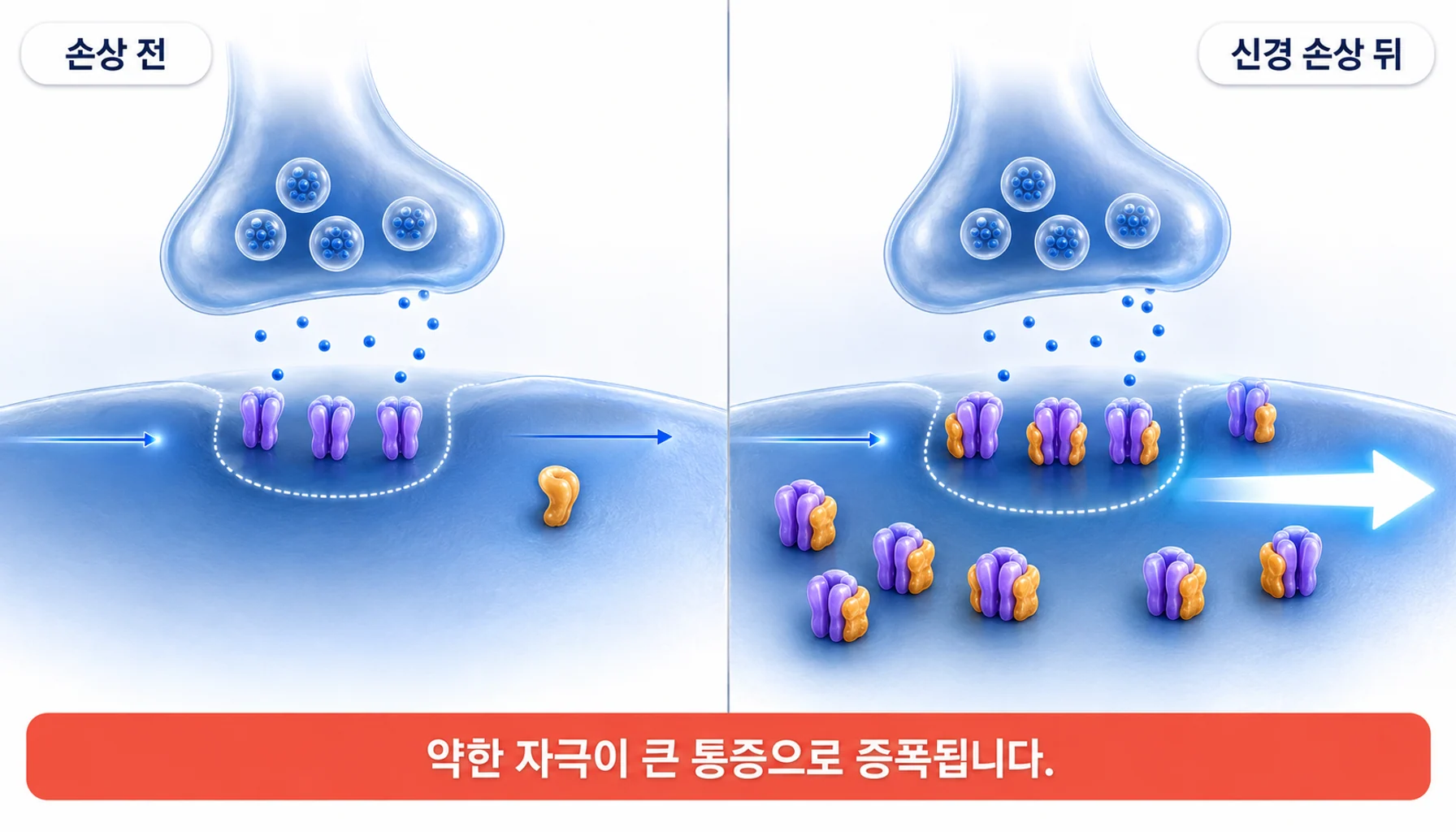 신경 손상 뒤 보조 소단위와 NMDA 수용체의 결합이 늘어 중추감작이 생기는 과정을 그린 그림
