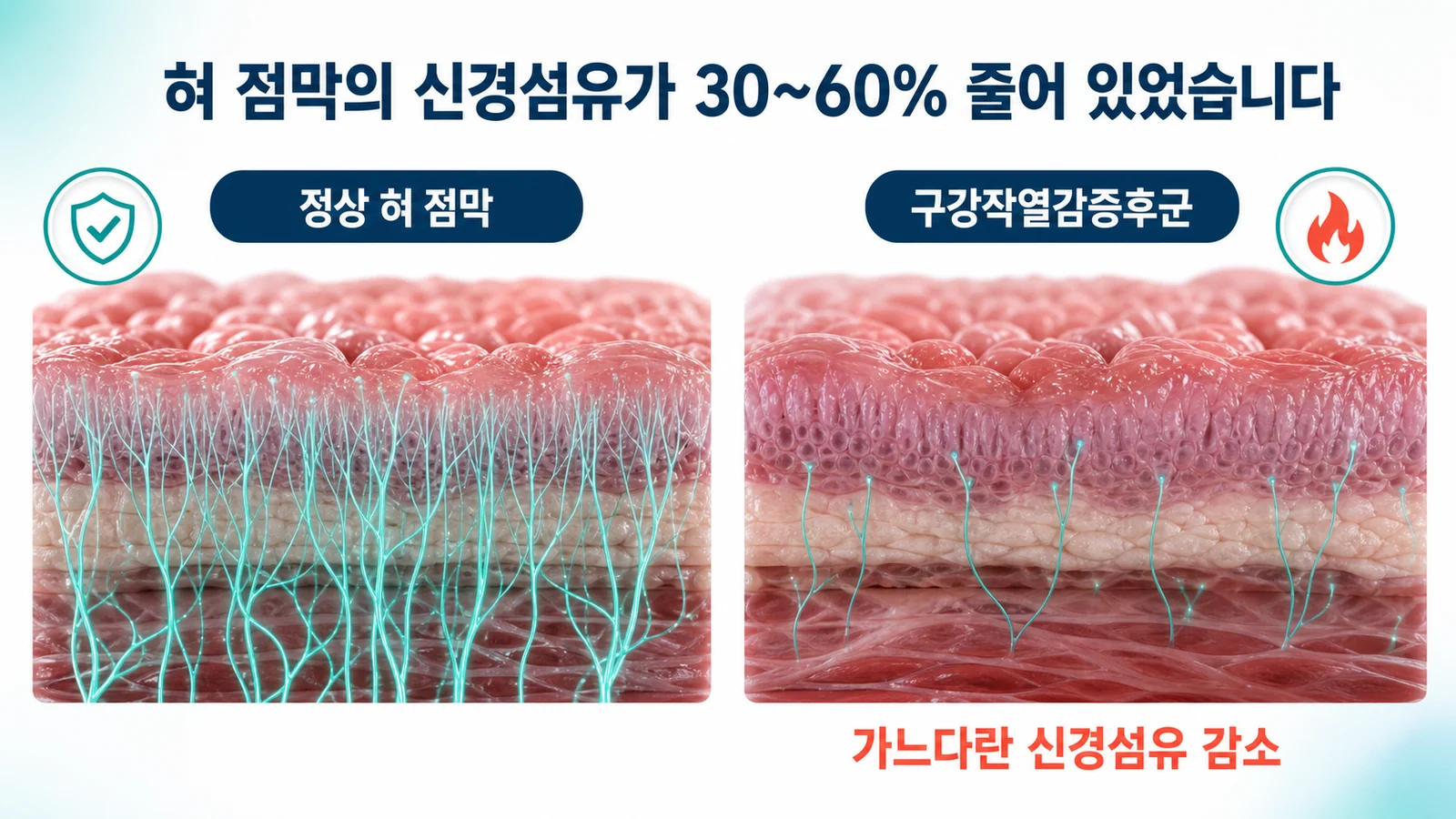 정상 혀 점막과 구강작열감증후군의 혀 점막을 비교한 그림. 정상 쪽은 가느다란 신경섬유가 촘촘히 올라와 있고 구강작열감증후군 쪽은 신경섬유가 뚜렷하게 줄어 있다