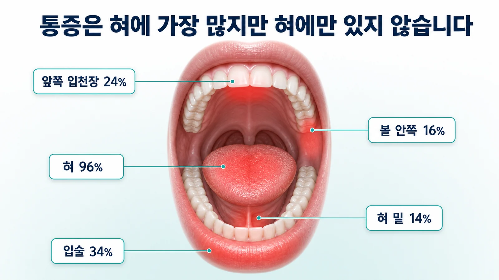 구강작열감증후군의 통증 부위 분포를 나타낸 그림. 혀 96퍼센트, 입술 34퍼센트, 앞쪽 입천장 24퍼센트, 볼 안쪽 16퍼센트, 혀 밑 14퍼센트가 표시되어 있다