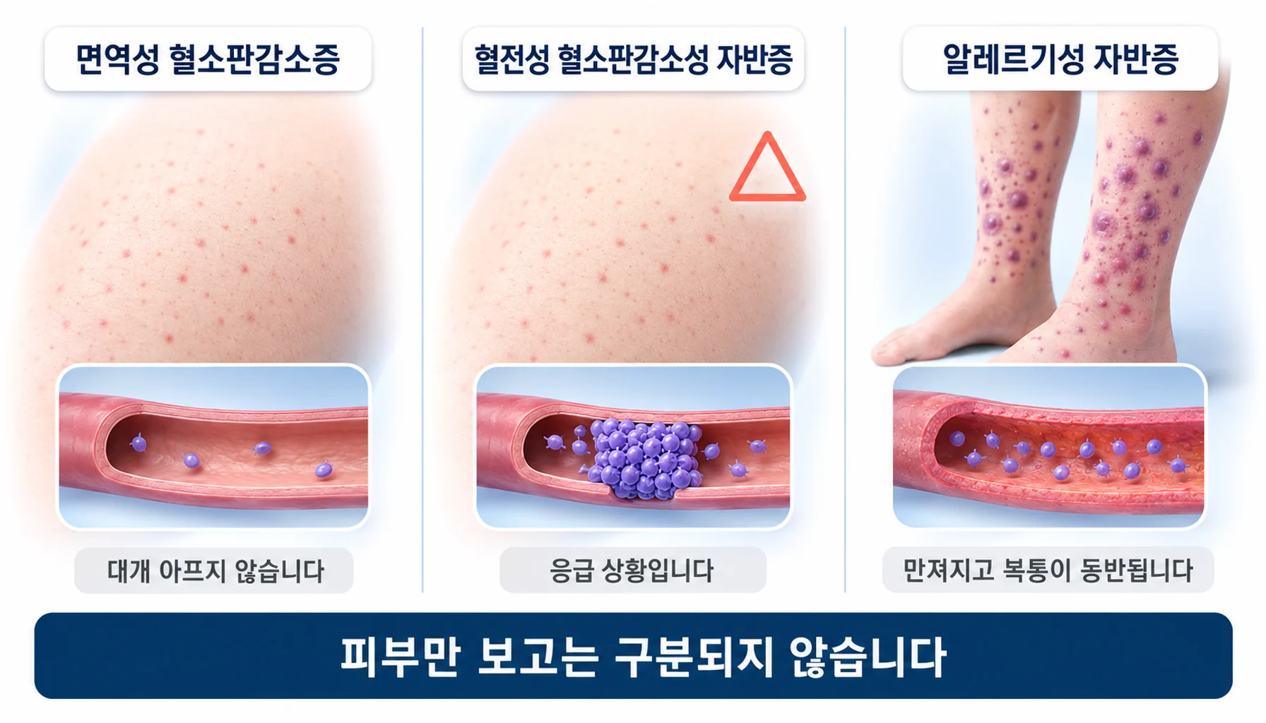 자반이 나타나는 세 가지 질환을 구분해 정리한 그림