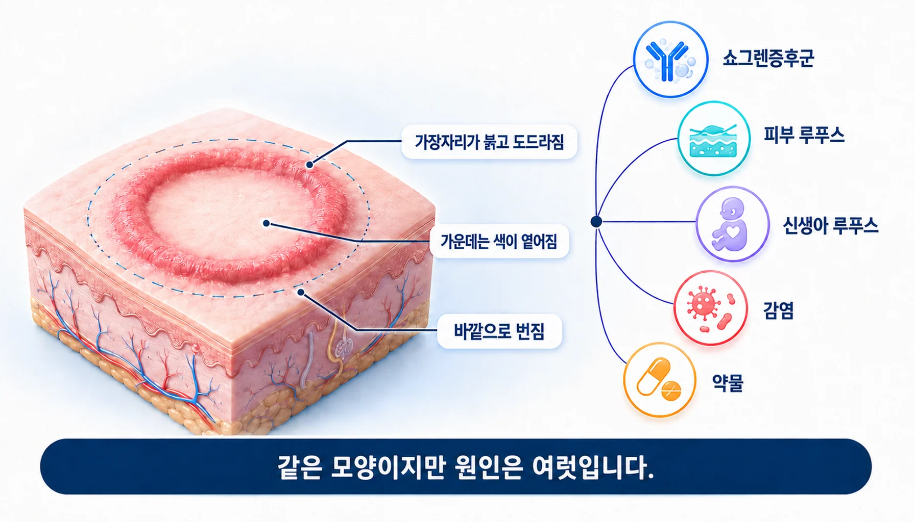 환상홍반의 공통된 모양과 원인이 여럿이라는 점을 그린 그림