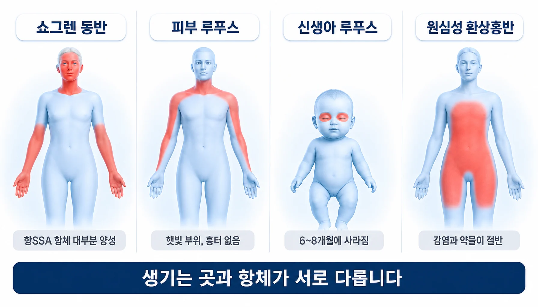 주요 환상홍반의 임상 특징을 나란히 비교한 그림