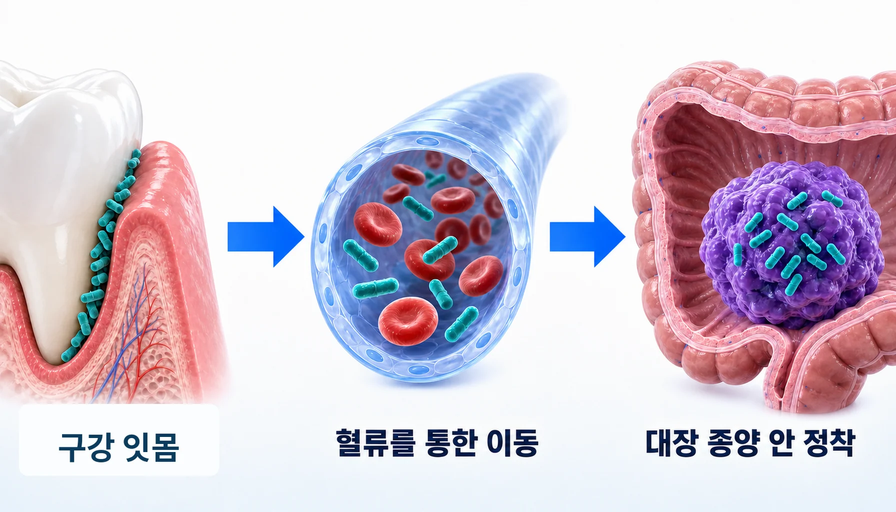 구강에서 혈류를 거쳐 대장 종양에 도달하는 세균의 경로를 그린 그림