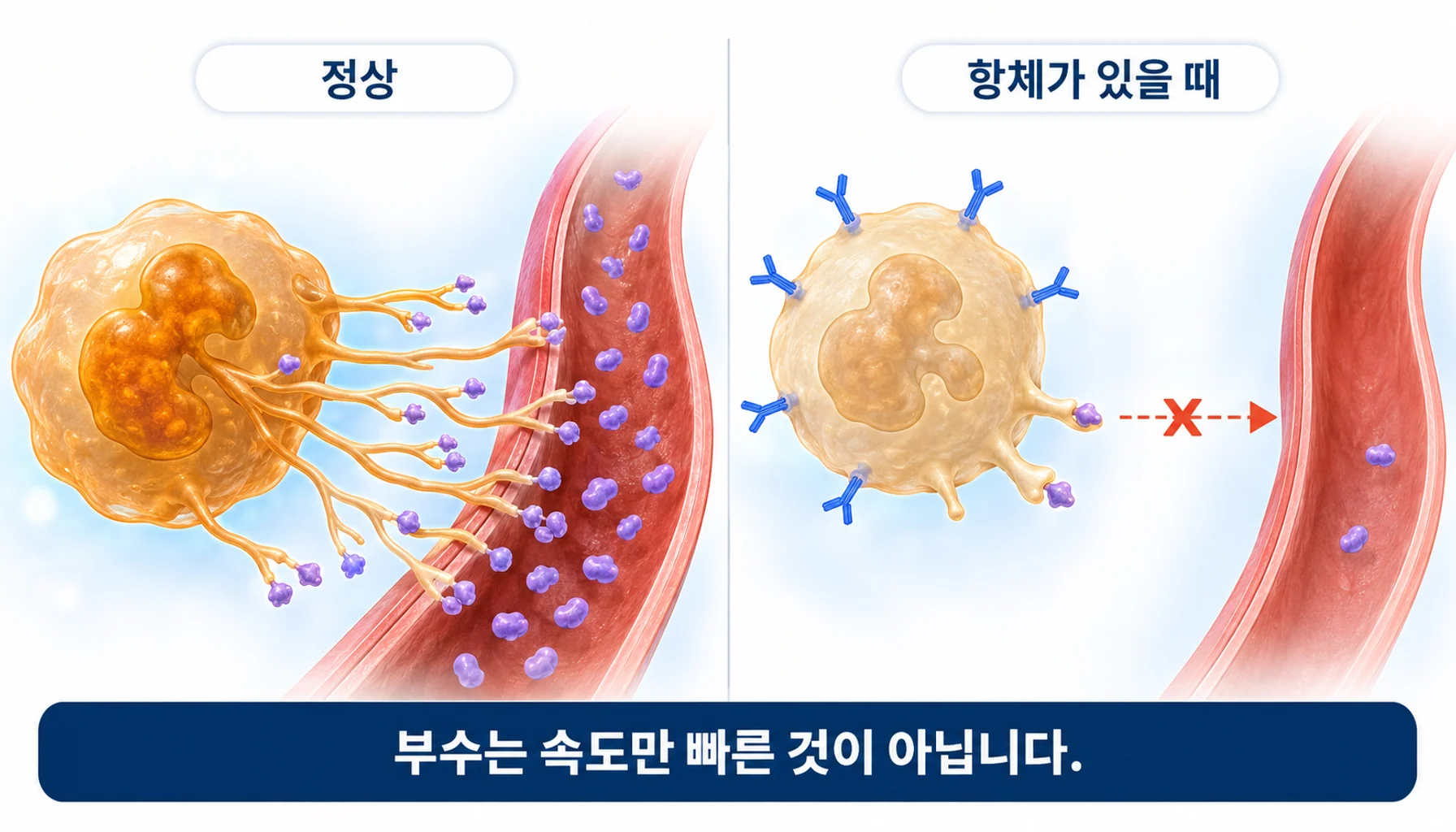 항혈소판 항체가 거대핵세포를 방해해 혈소판 생성을 줄이는 과정을 그린 그림