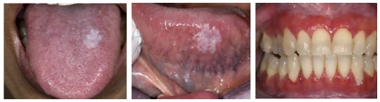 인천 구강 편평태선 Oral lichen planus 입안 점막 병변