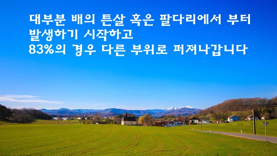 임신소양증이 나타나는 부위를 설명하는 이미지