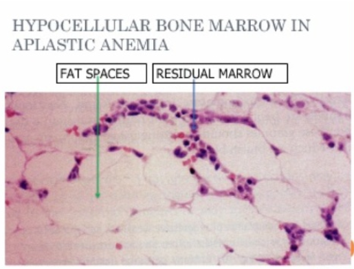재생 불량성 빈혈(aplastic anemia) 자가면역이 원인일 수 있습니다