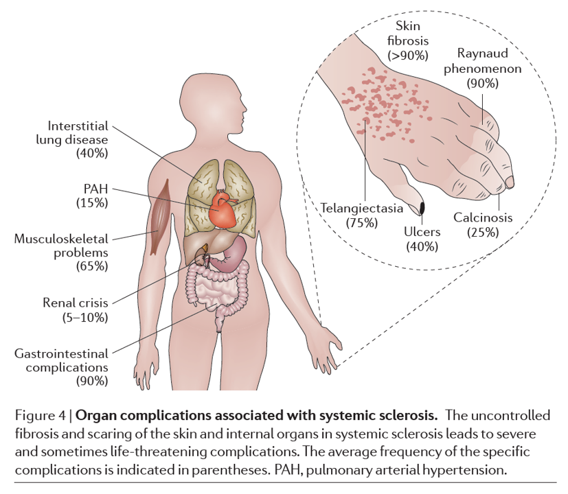 전신경화증 합병증 간질성 폐질환과 한의학 치료 기대 효과 알아보기