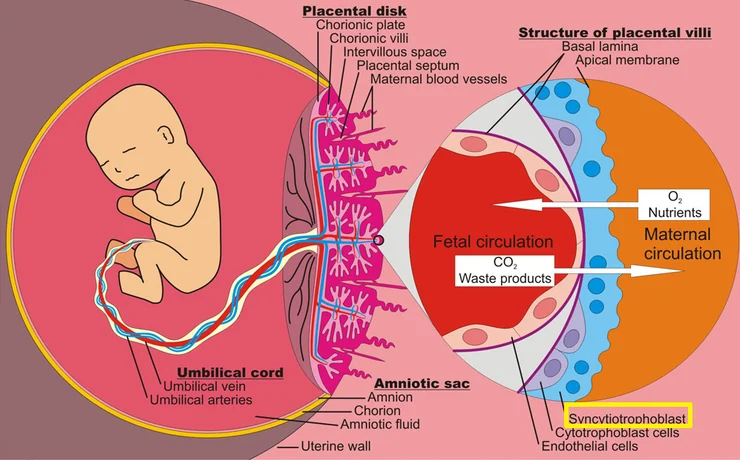 HELLP syndrome과 자간전증의 태반병리 모식도