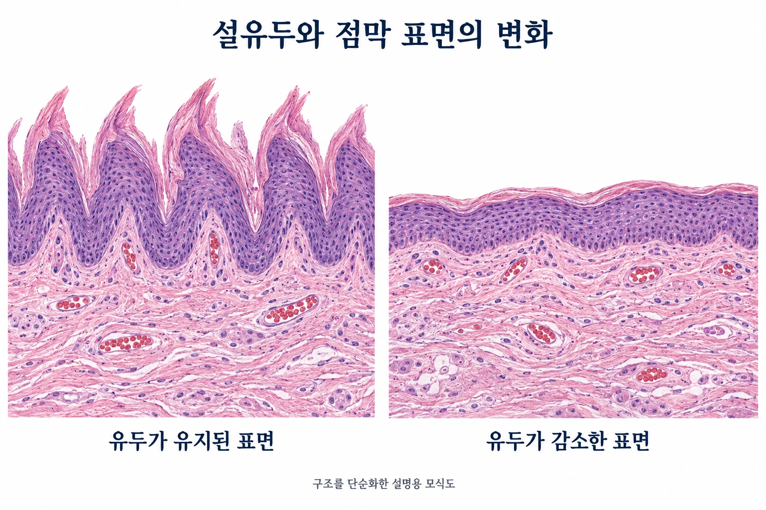 혀의 유두가 유지된 표면과 위축된 표면의 점막 구조를 비교한 설명용 단면도