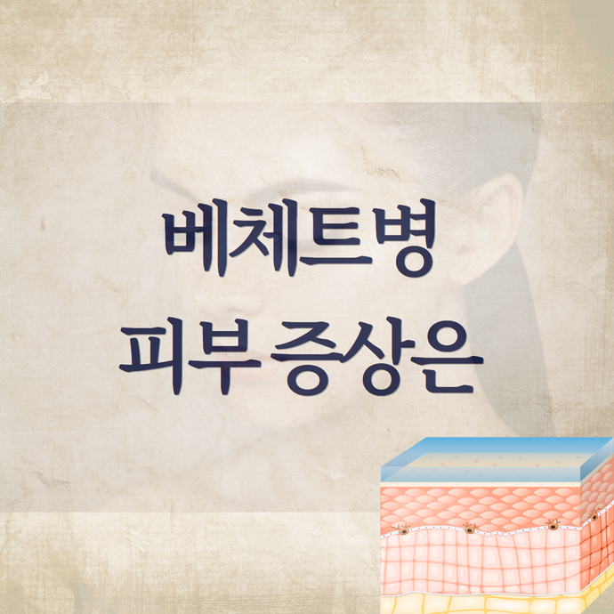 베체트병 증상 - 피부에 나타나는 모낭염 가성모낭염 (여드름 뾰루지)