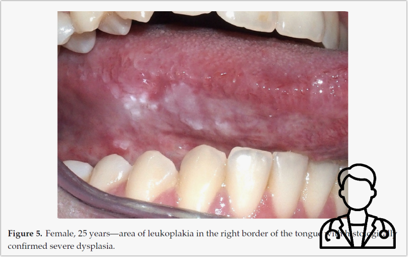 BMS vs 구강암 비교