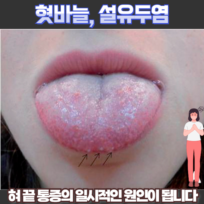 설유두염 분류