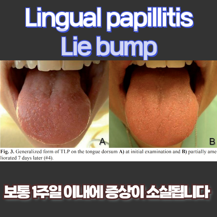 약물 유발 BMS 사례