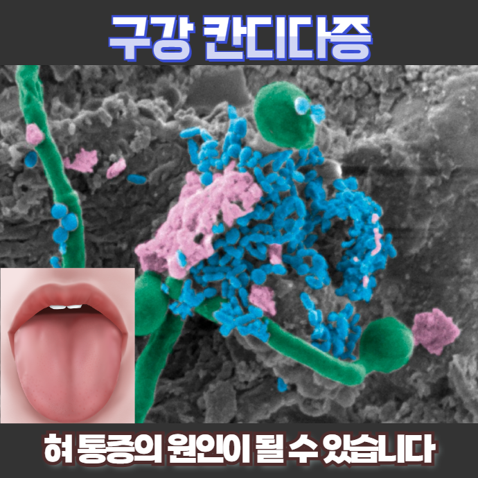 또 다른 약물 유발 사례